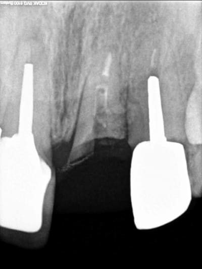 Radio 21 fractur e kbb2or - Eugenol