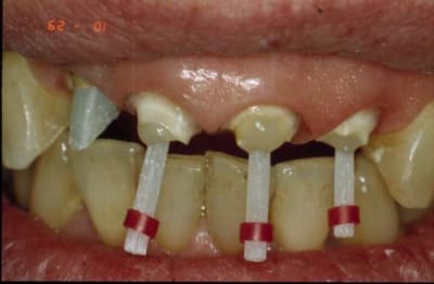 Reconstitution 1 lfbinh - Eugenol