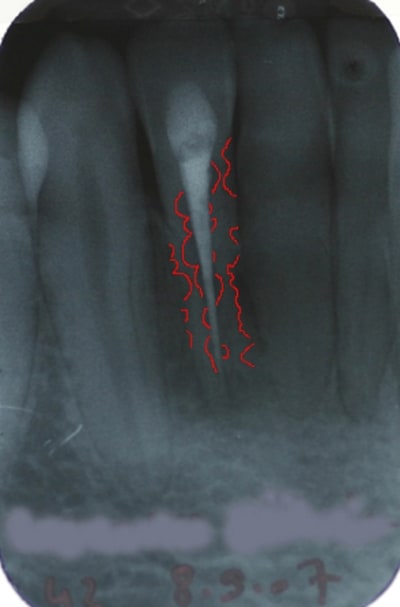 Resorption chqiaw - Eugenol