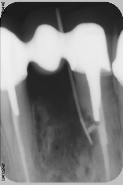 Resorption ext wxiezg - Eugenol