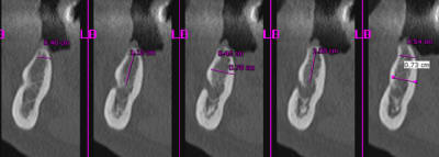 Scan4 foramen 45 m6pcr3 - Eugenol