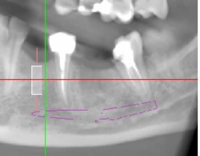 Scanner 34 avec un 8 mm hb4pob - Eugenol