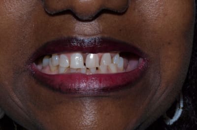 Simulation sans allonger le bord libre des dents maxillaires a63wko - Eugenol