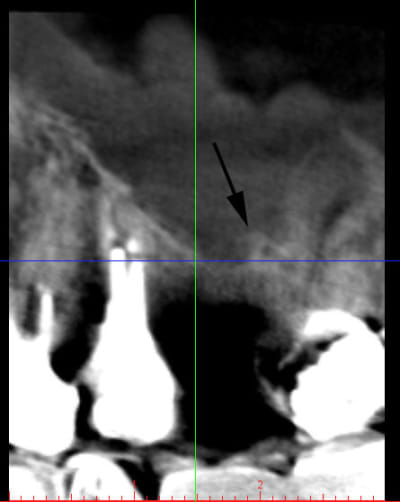 Sinus cloison 1 jg4fm0 - Eugenol