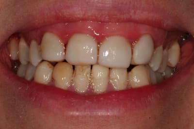 Sourir s2tfm0 - Eugenol