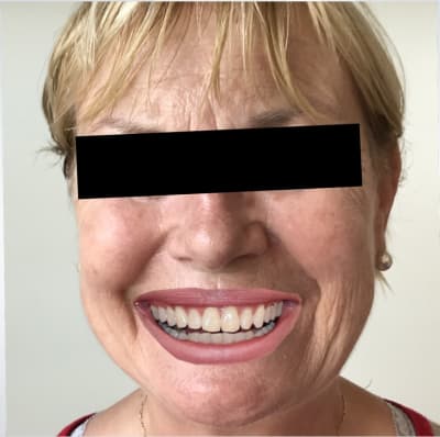 Sourire de simone paint keokrv - Eugenol