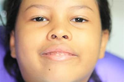 Sourire gingival   6 ans 002  medium  fgolap - Eugenol