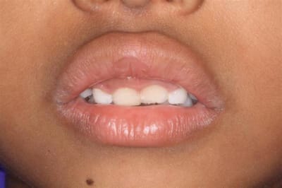 Sourire gingival   6 ans 009  medium  dqbarl - Eugenol