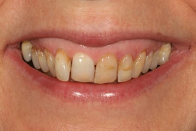 Sourire kadakg - Eugenol