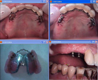 Stellite   implant kyve51 - Eugenol