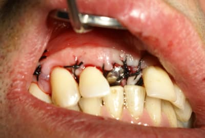 Sutures et occlusion nhjrec - Eugenol