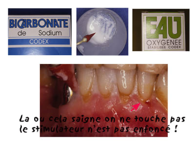 Test de stimulation   charo uesnz4 - Eugenol
