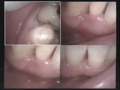 Un cas difficile paro à 8 jours 1 risljt - Eugenol