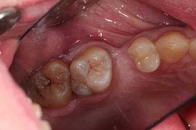 Vrai patient2 du5hmy - Eugenol