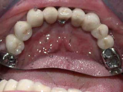 Vue linguale roe3wr - Eugenol