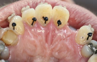 Vue palatine yygg5c - Eugenol