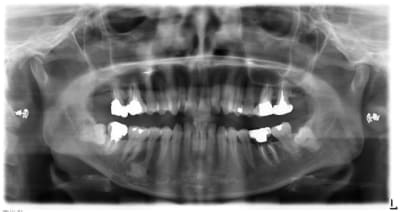 Zone osteodense hmxufg - Eugenol