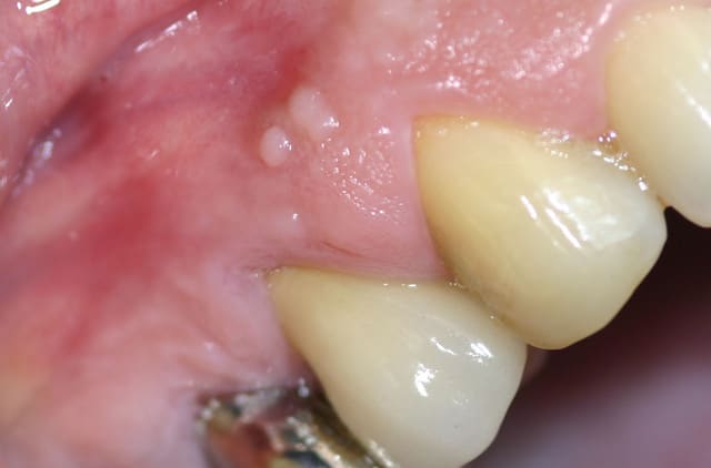 boutons gingivaux - Eugenol