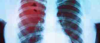 An X-ray image of a chest, revealing two lungs with ribcage outline. The left lung shows a red highlighted area indicating a possible medical concern or abnormality. The right lung appears normal with no highlighted areas.