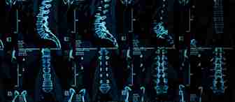 A collage of spinal MRI scans showing multiple views and sections of the human spine, including cervical, thoracic, and lumbar regions, displayed in blue and black tones on a medical imaging screen.
