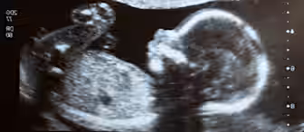Black and white ultrasound image showing a side profile of a developing fetus. Distinct features include the head, abdomen, and limbs. Various clinical markers and measurements are displayed on the sides of the image.