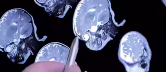 A series of black and white brain MRI scans showing sagittal views of the brain. A hand is holding a pen, pointing at a particular spot on one of the scans, indicating an area of interest. The scans display detailed anatomical structures of the brain.