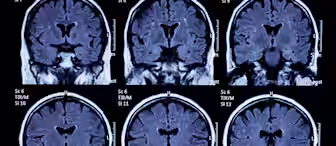 The image shows six coronal MRI brain scans, labeled sequentially from 7 to 12, displaying different cross-sectional views from T1-weighted sequences. The scans reveal detailed brain structures used for medical analysis and diagnosis.