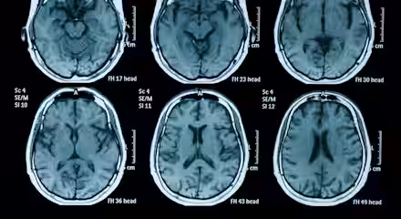 MRI scan displaying six cross-sectional images of a human brain, showcasing different levels from the base to the top. Each image is labeled with various numbers and letters. The images show the brain's internal structures in shades of black, white, and gray.