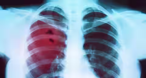 An X-ray image of a chest, revealing two lungs with ribcage outline. The left lung shows a red highlighted area indicating a possible medical concern or abnormality. The right lung appears normal with no highlighted areas.