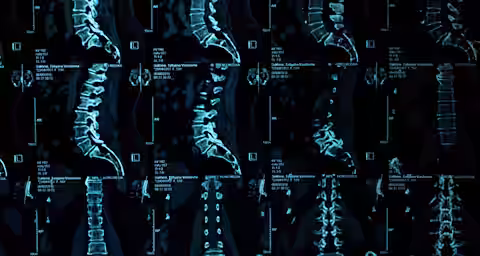 A collage of spinal MRI scans showing multiple views and sections of the human spine, including cervical, thoracic, and lumbar regions, displayed in blue and black tones on a medical imaging screen.