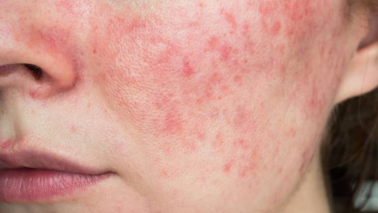 Rosacea