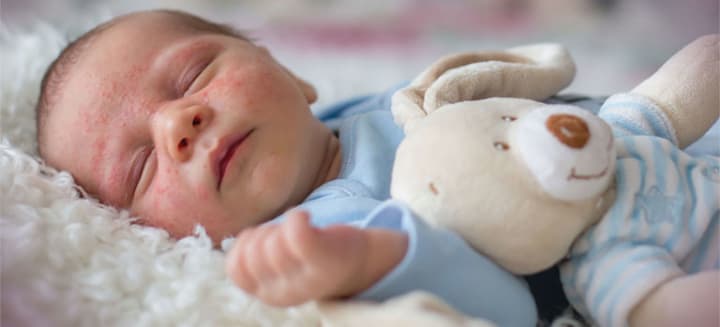 CÁCH TRỊ MỤN SỮA CHO TRẺ SƠ SINH ĐÚNG CÁCH VÀ SIÊU HIỆU QUẢ