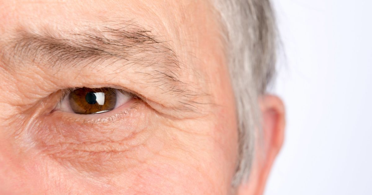 Sagging upper hot sale eyelid