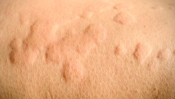 Dry Raised Bumps On Skin