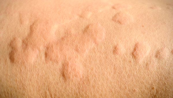 Small collection of light-red hives on a person with light skin