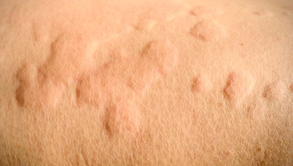 Common Causes Of Itchy Red Bumps On Skin Sexiezpix Web Porn