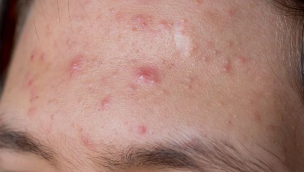 Lumps & Bumps - Cause for Concern?: Warrenton Dermatology & Skin