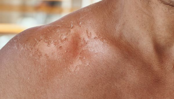 What Does Skin Cancer Really Look Like? | Skin Cancers ...