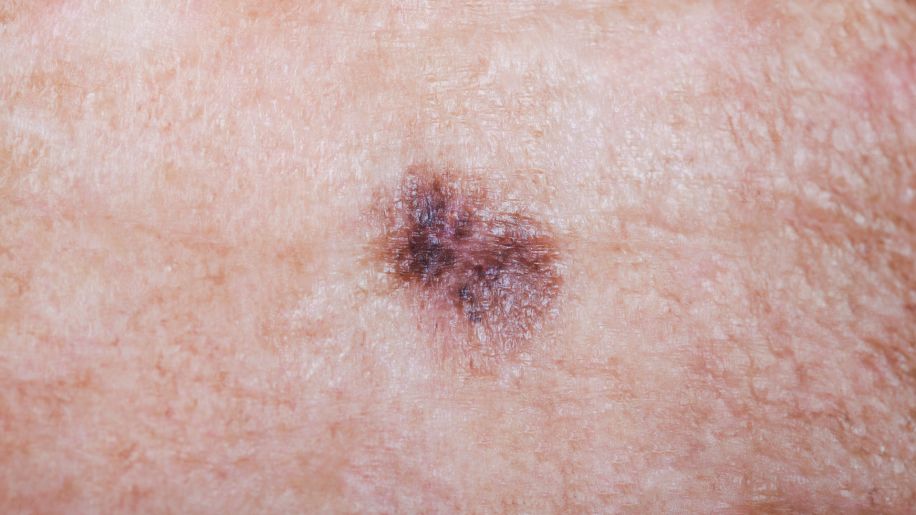 What Does Skin Cancer Really Look Like Cancer Sharecare