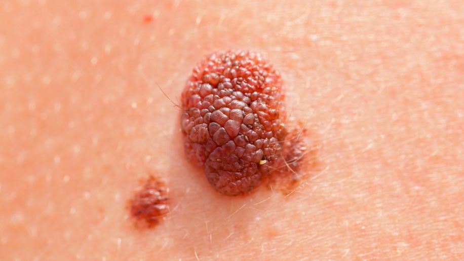 Closeup of skin cancer.