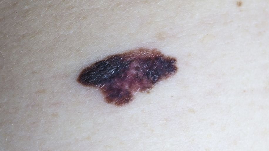 asymmetrical melanoma