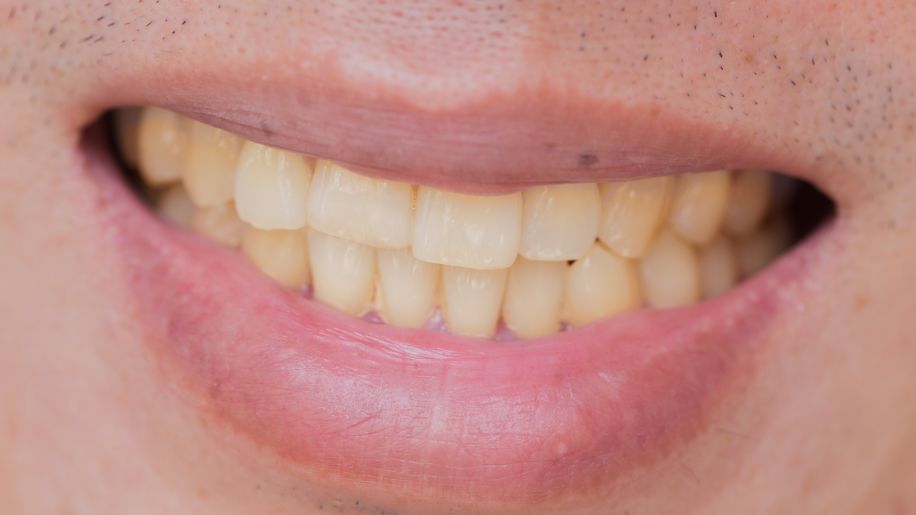 female smoker's yellow teeth