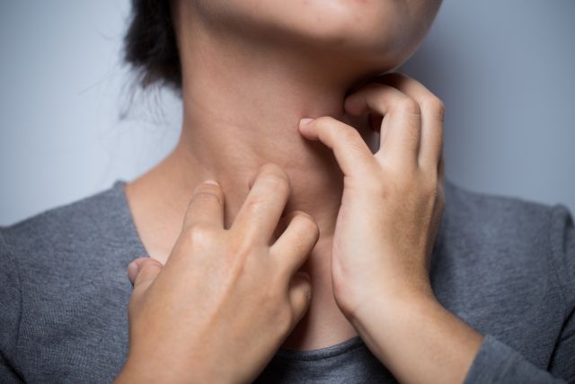 A woman scratches her hives—one of the signs of food allergies. Most common foods for allergies are milk, eggs and peanuts.