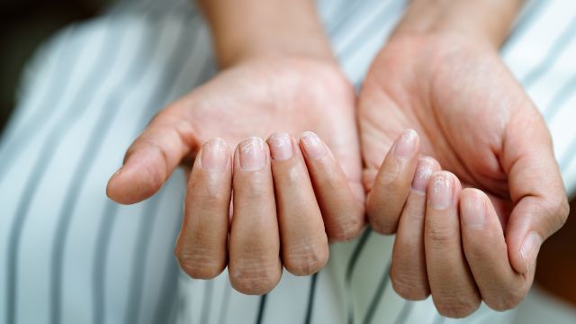 A man examines his nails looking for symptoms of psoriatic arthritis in his hands.  