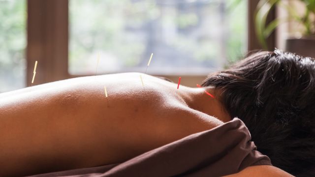 Person gets accupuncture on back.