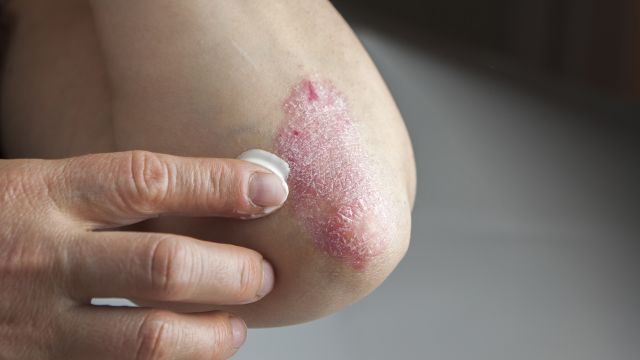 Psoriasis on a man's elbow.