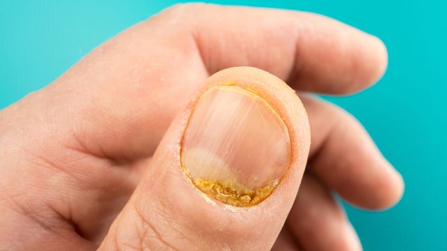 Hand with nail psoriasis on thumb.