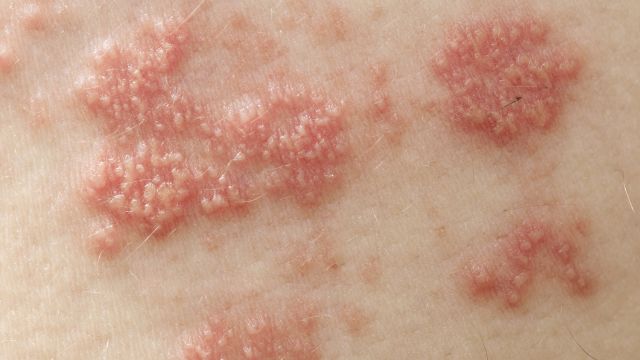Closeup of a shingles rash.