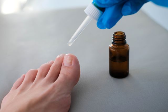 closeup of a foot while a doctor drips medicine from a pipette to treat psoriasis