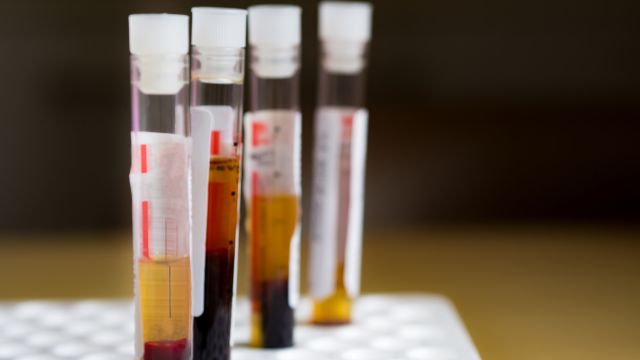 Blood vials in a standing rack waiting to be tested for immune thrombocytopenia (ITP).